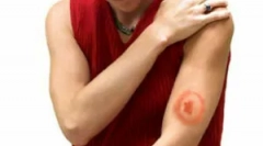 Liječenje krpeljne borrelioze