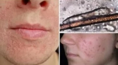 Analiza isporuke na demodekozi