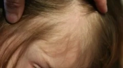 Uši i kratke hlače u njezinoj kosi u djetetu